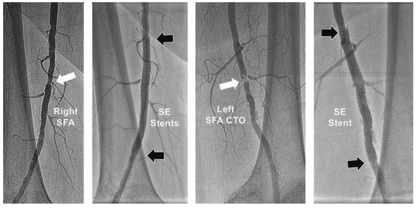 Minor Endovascular Therapy Figure 3B