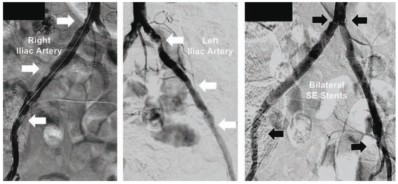 Minor Endovascular Therapy Figure 4