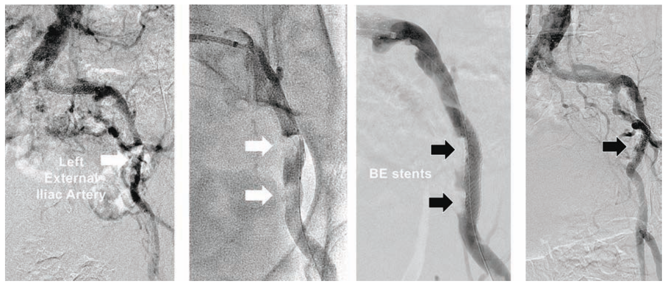 Minor Endovascular Therapy Figure 5