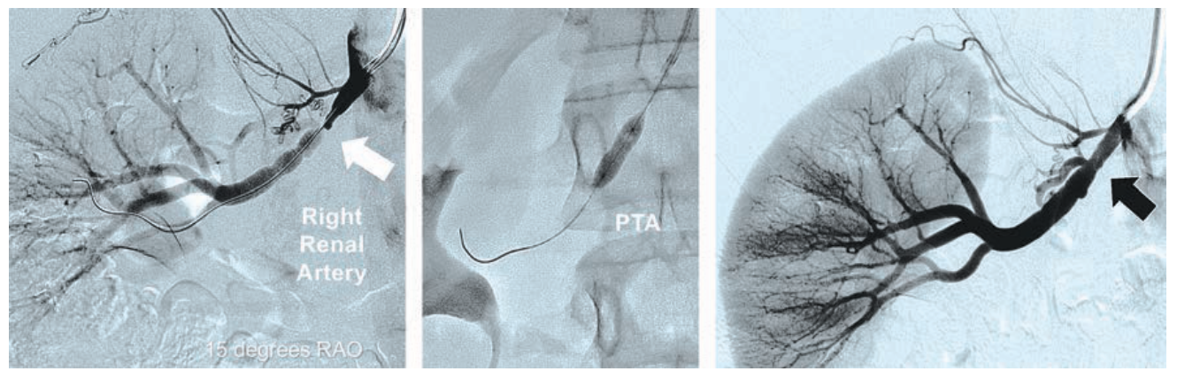 Minor Endovascular Therapy Figure 6