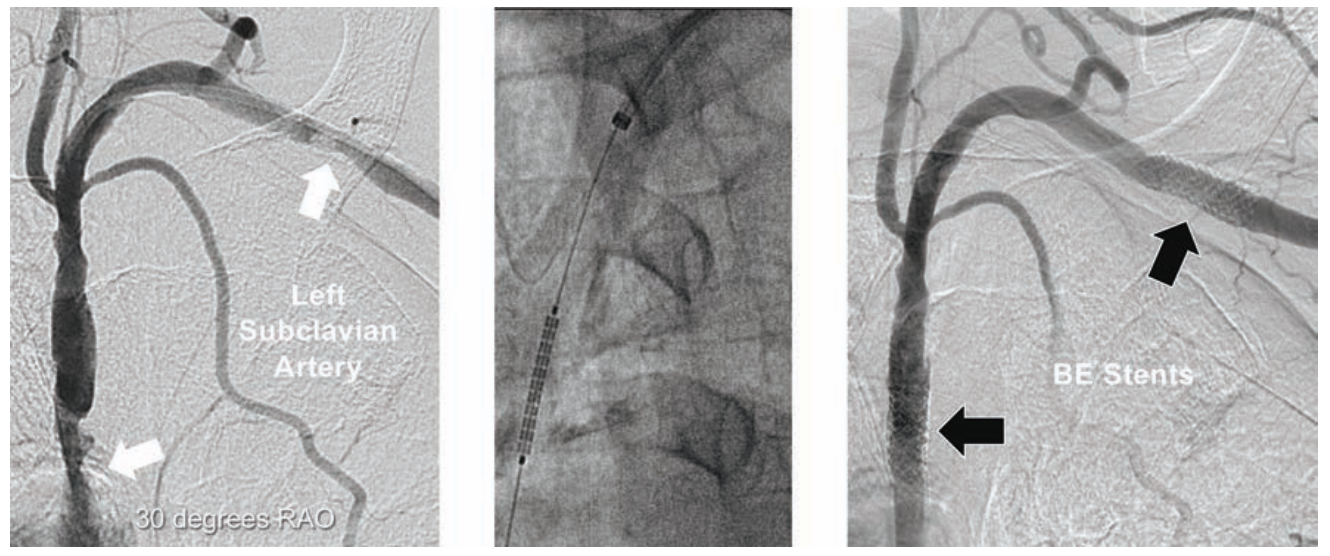 Minor Endovascular Therapy Figure 7