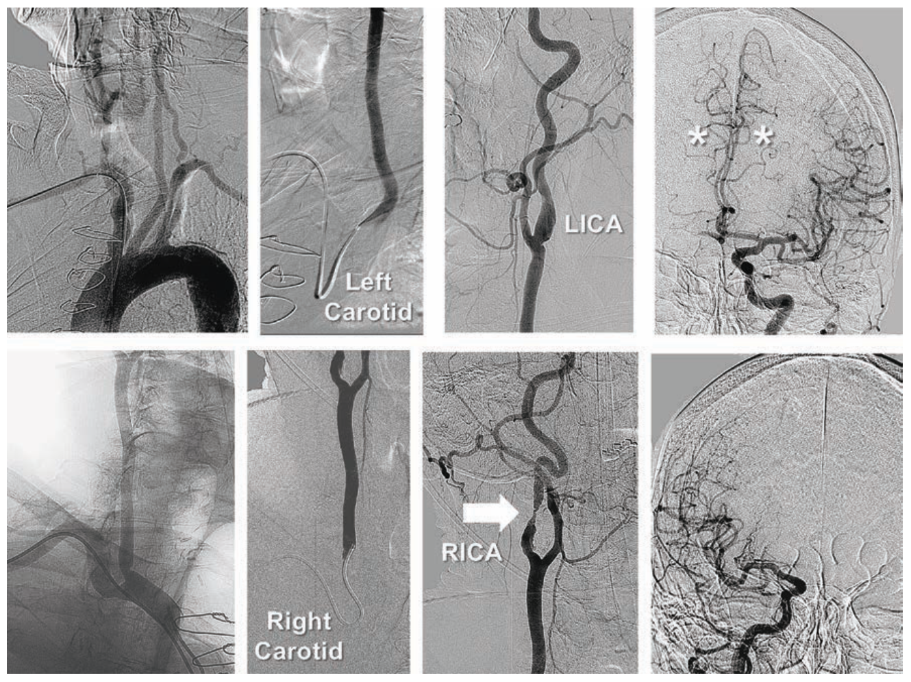 Minor Endovascular Therapy Figure 8A