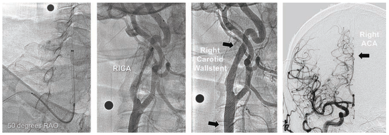 Minor Endovascular Therapy Figure 8B