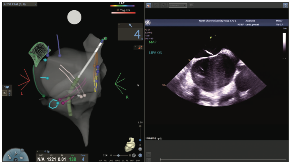 Mitra Catheter Ablation Figure 10