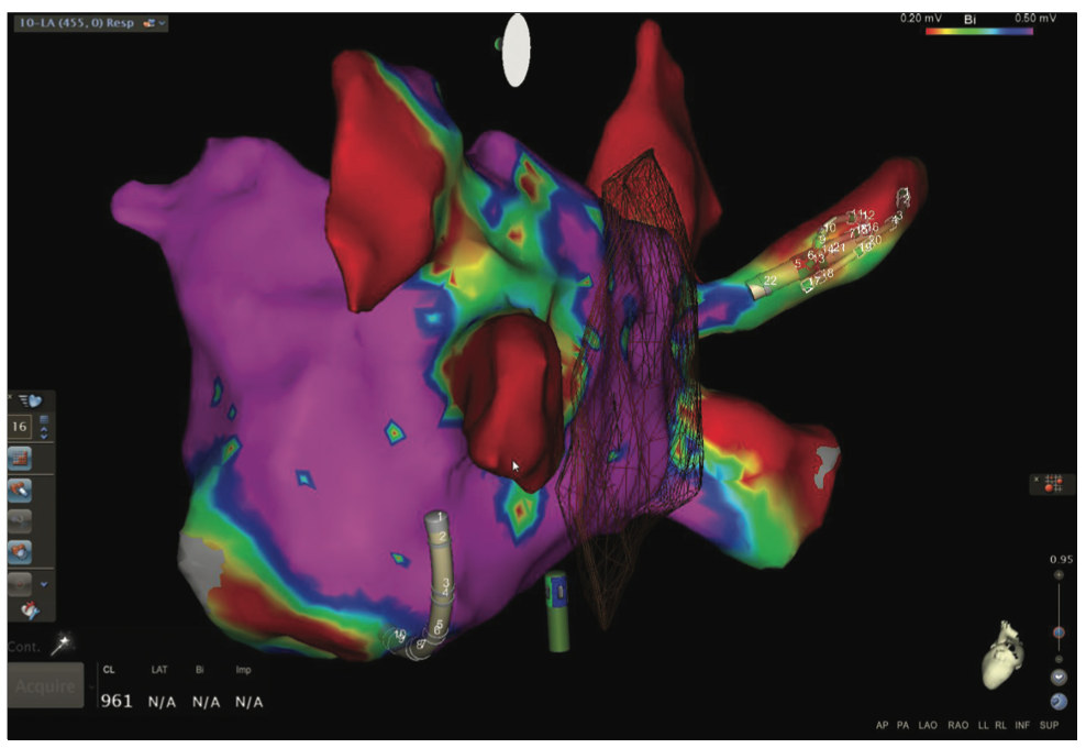 Mitra Catheter Ablation Figure 11B