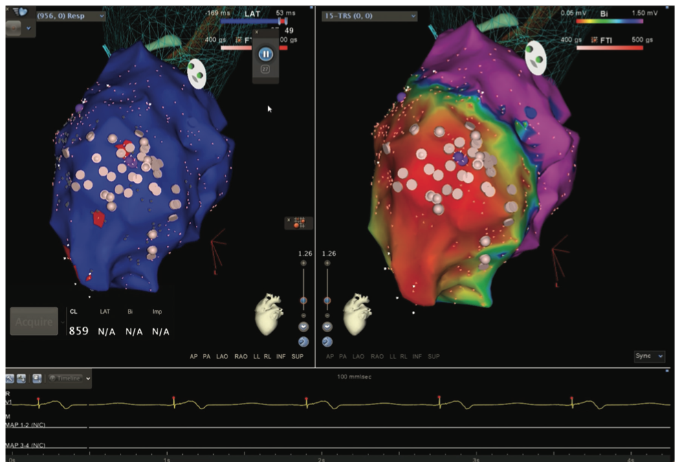Mitra Catheter Ablation Figure 13B