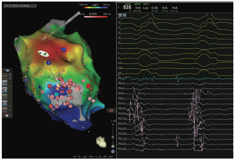Mitra Catheter Ablation Figure 13C