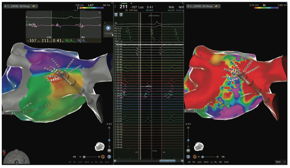 Mitra Catheter Ablation Figure 14