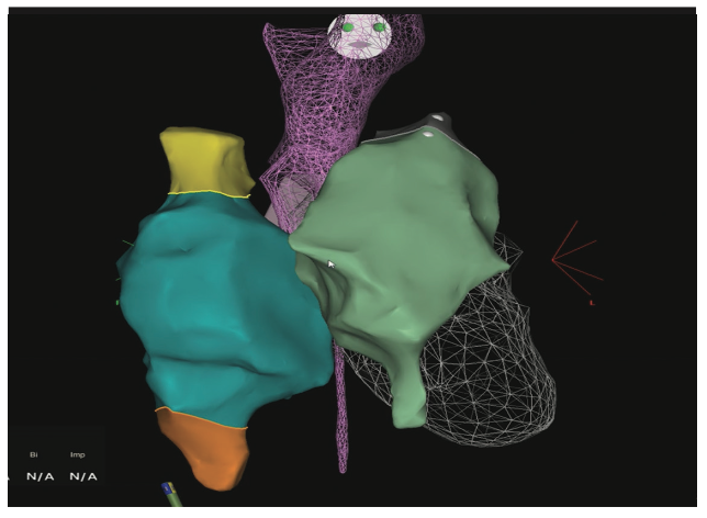 Mitra Catheter Ablation Figure 15A