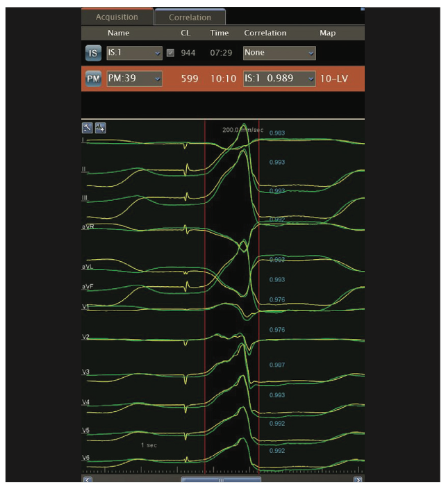 Mitra Catheter Ablation Figure 15B