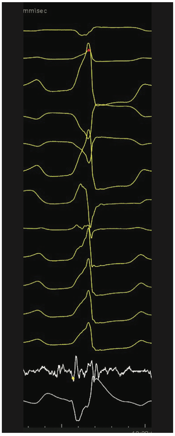 Mitra Catheter Ablation Figure 15C