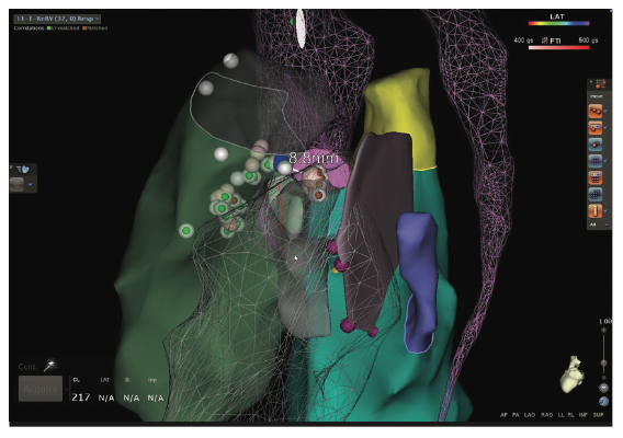 Mitra Catheter Ablation Figure 15D
