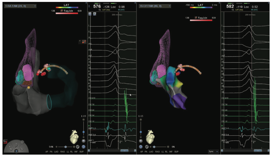 Mitra Catheter Ablation Figure 16A