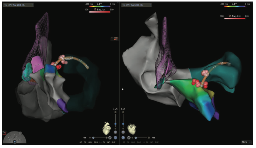 Mitra Catheter Ablation Figure 16B