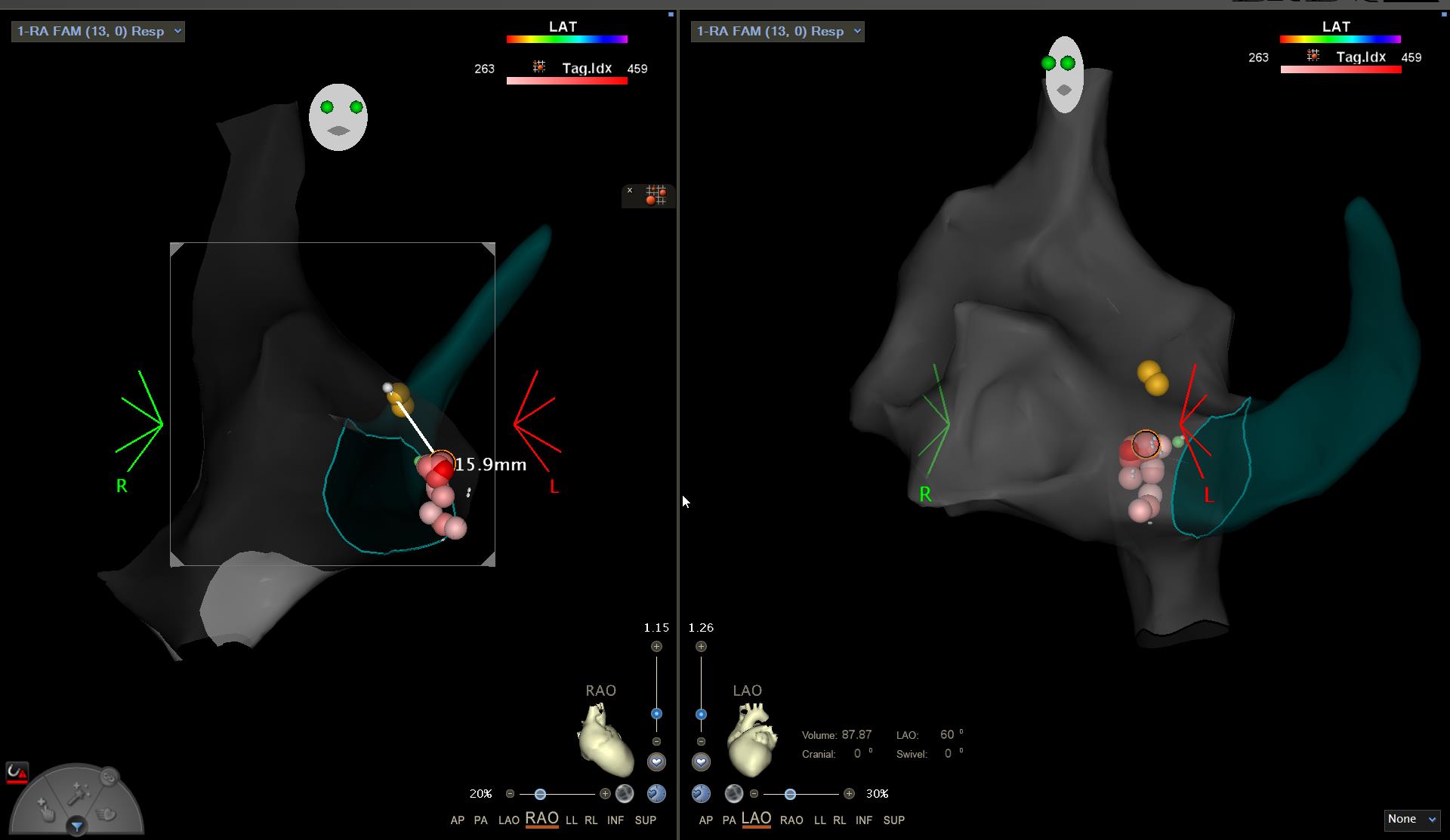 Mitra Catheter Ablation Figure 17