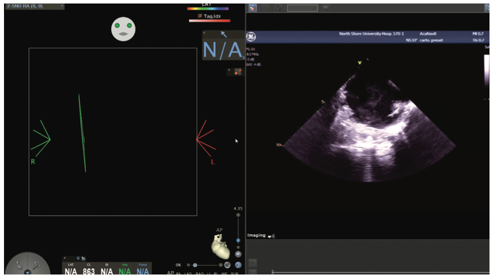 Mitra Catheter Ablation Figure 2