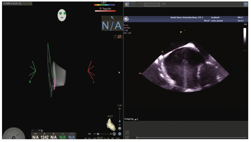 Mitra Catheter Ablation Figure 3