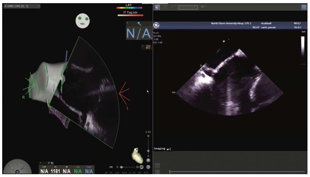 Mitra Catheter Ablation Figure 4