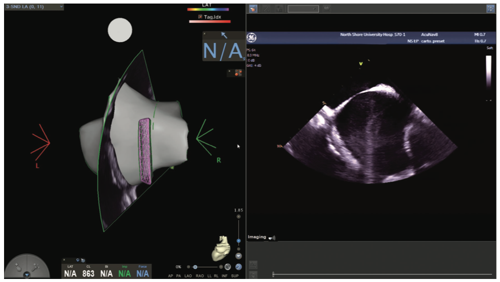 Mitra Catheter Ablation Figure 5