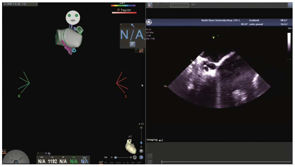 Mitra Catheter Ablation Figure 6