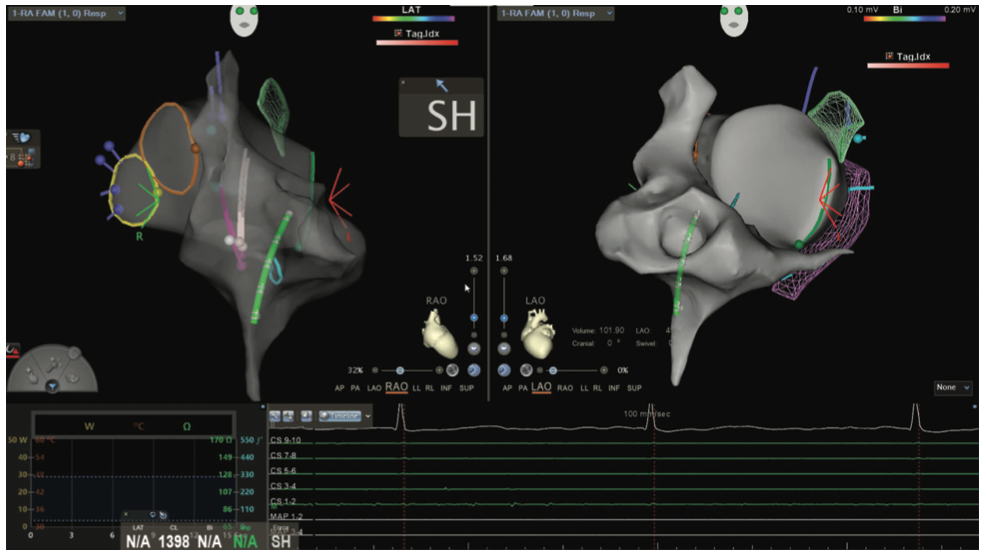 Mitra Catheter Ablation Figure 7