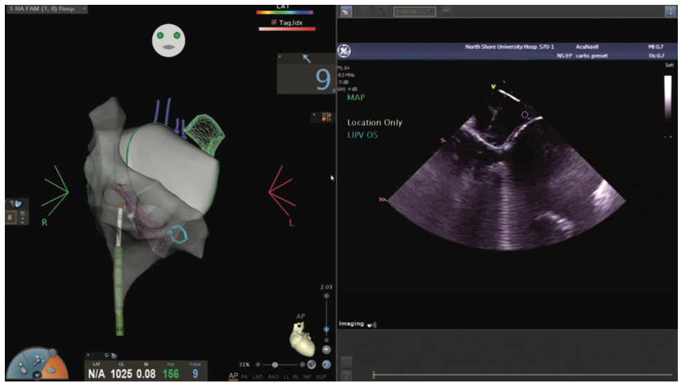 Mitra Catheter Ablation Figure 8