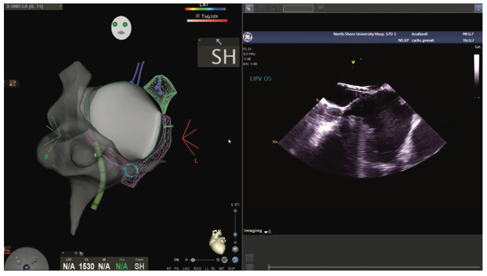 Mitra Catheter Ablation Figure 9