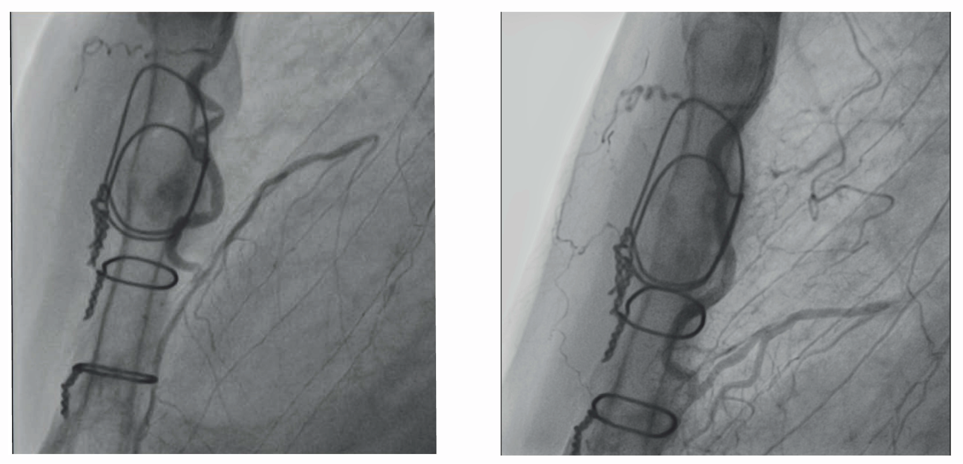 Figure 3. Improvement of left internal mammary artery -graft stenoses 