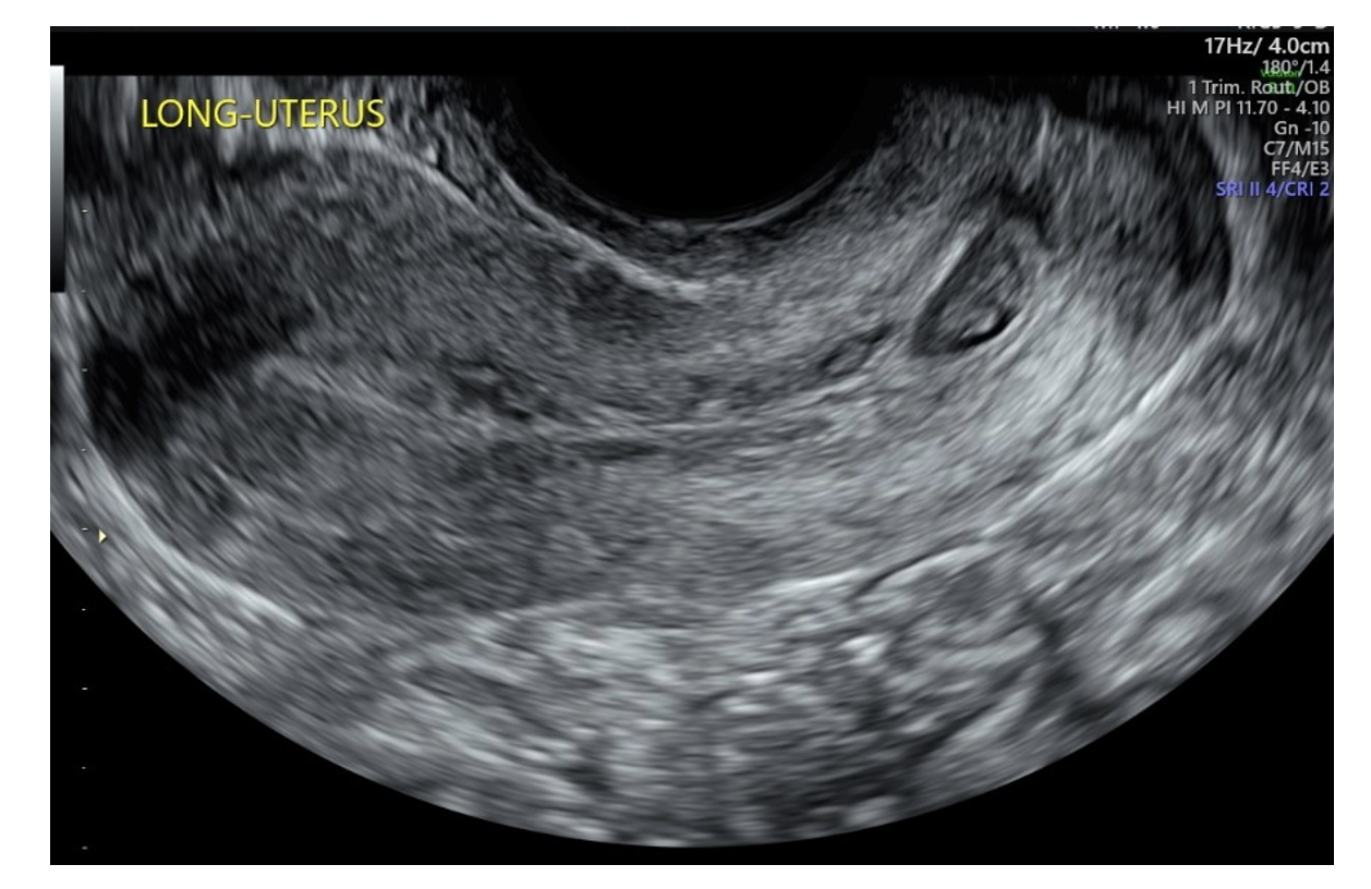 Figure 1. Preprocedural ultrasound demonstrating gestational sac in the cervical canal and no fluid or sac in the endometrial canal.