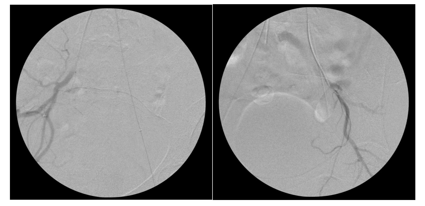 Figure 2 and Figure 3. Intra-procedural digital subtraction angiograms demonstrating catheter position in the internal iliac arteries bilaterally.