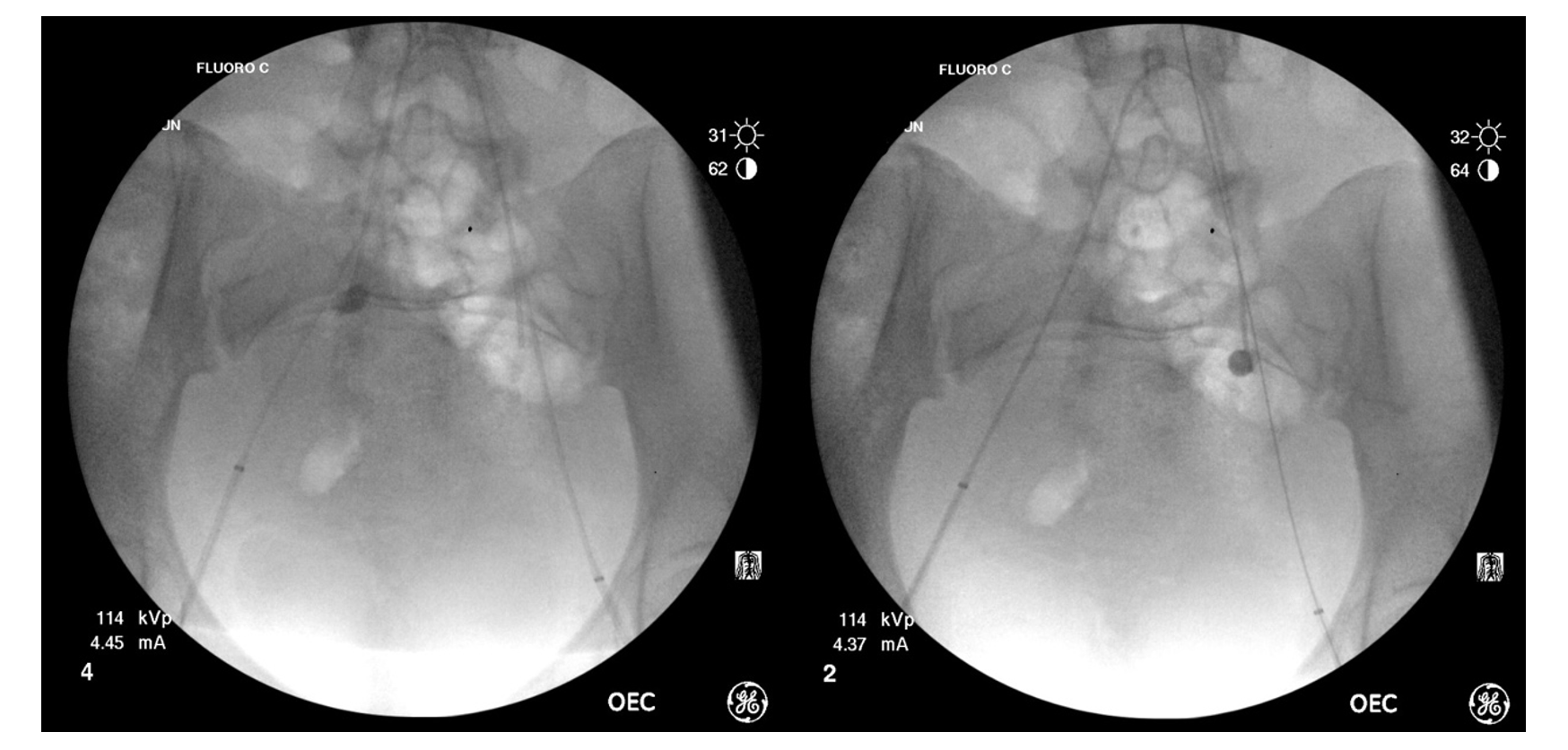 Figure 5 and Figure 6. Intraoperative fluoroscopic images demonstrating inflated Fogarty balloons in the bilateral internal iliac arteries.