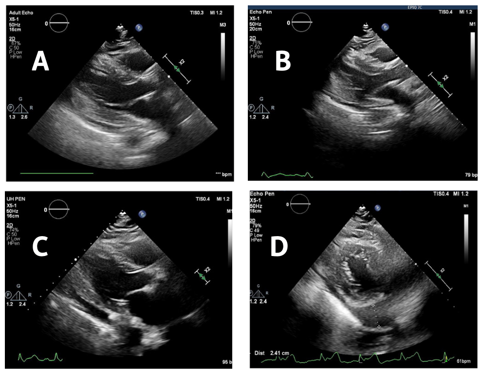 Mogalapalli Pericardial Effusion Figure 1
