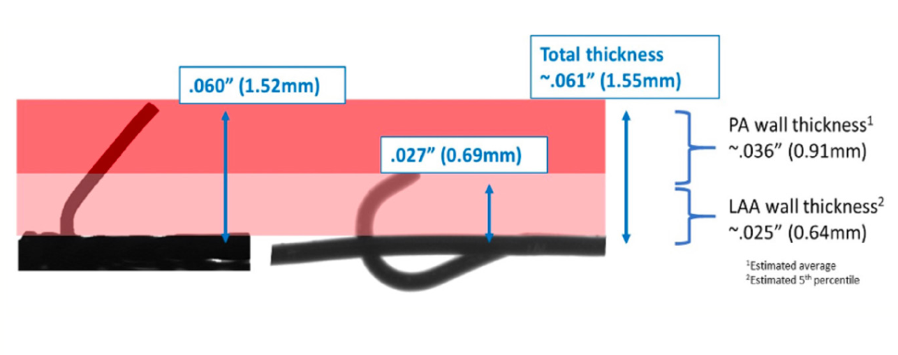 Mogalapalli Pericardial Effusion Figure 2