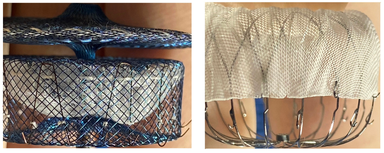 Mogalapalli Pericardial Effusion Figure 3