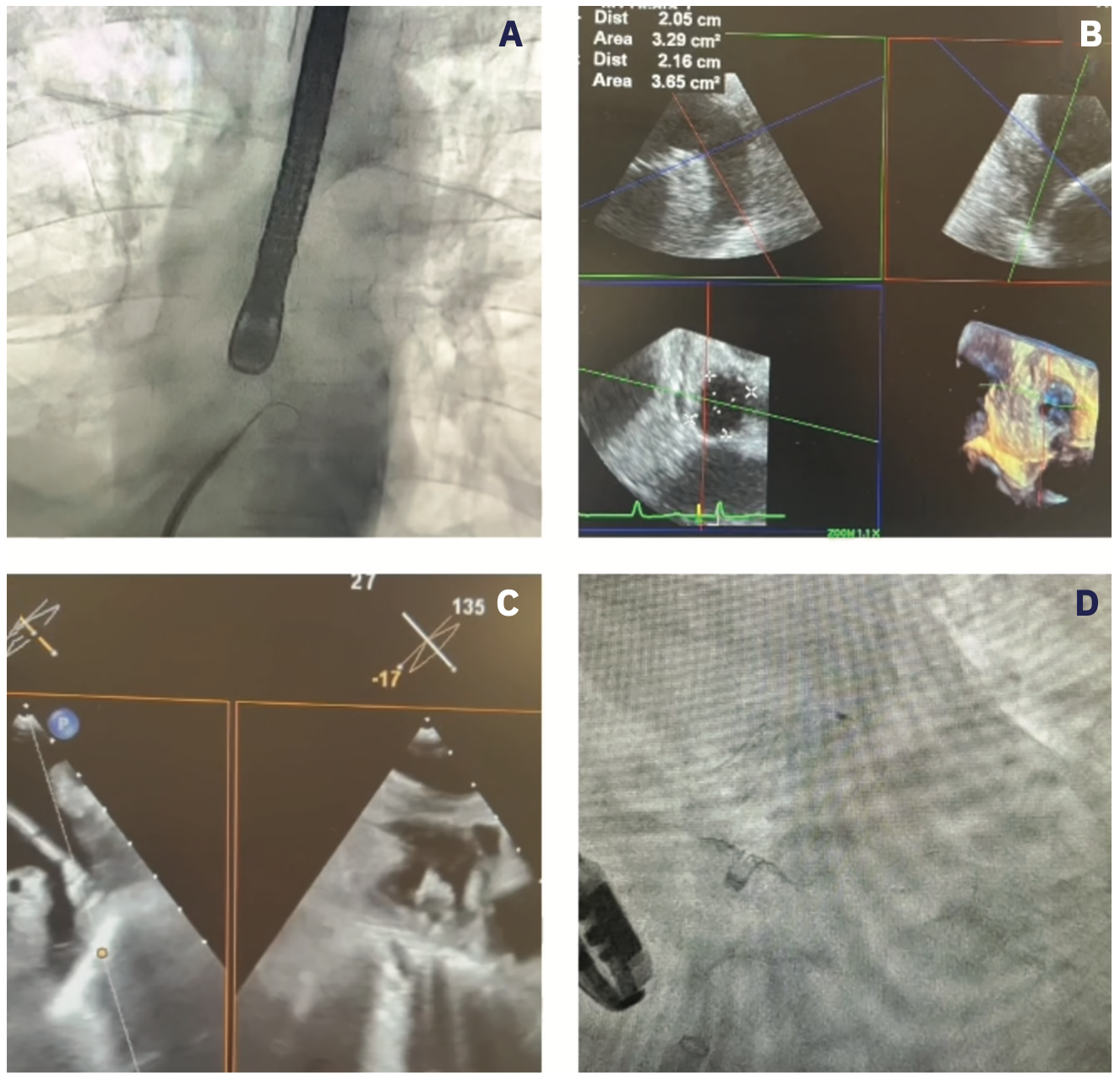 Mohan Left Atrial Appendage Figure 2