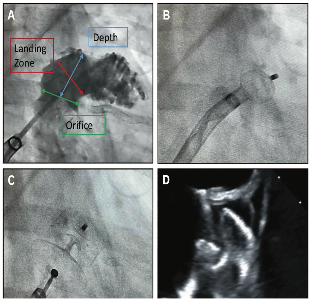 Mohan Left Atrial Appendage Figure 4