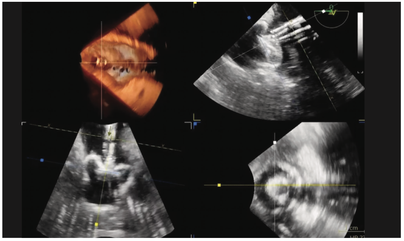 Mohan Left Atrial Appendage Figure 5