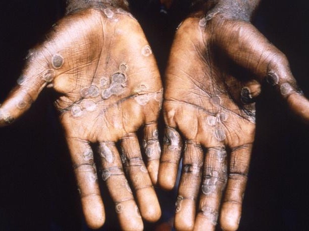 Monkeypox lesions on the hands of an African victim in 1997 (Photo: CDC/Public Health Image Library) 