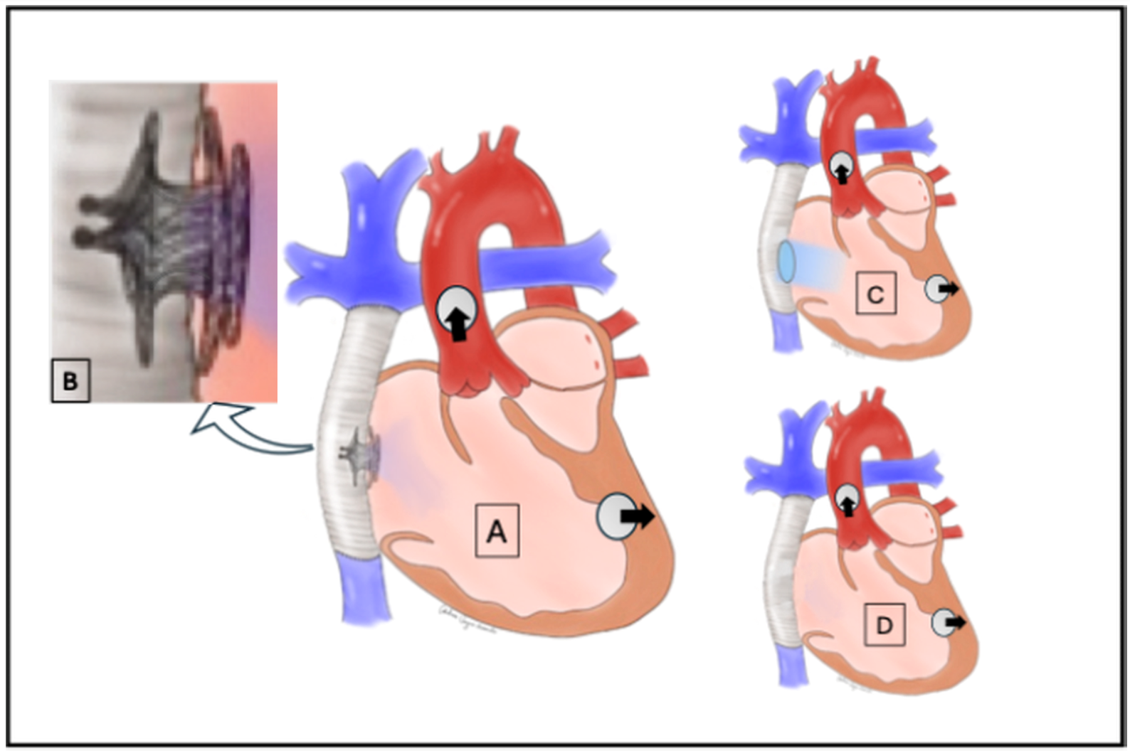 Figure 3. Illustration of the anatomy of the patient in Case 2: Failing Fontan with systemic ventricular assist device 