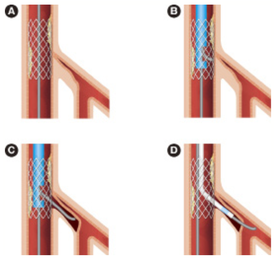 Morita Side-Branch Occlusion Figure 1