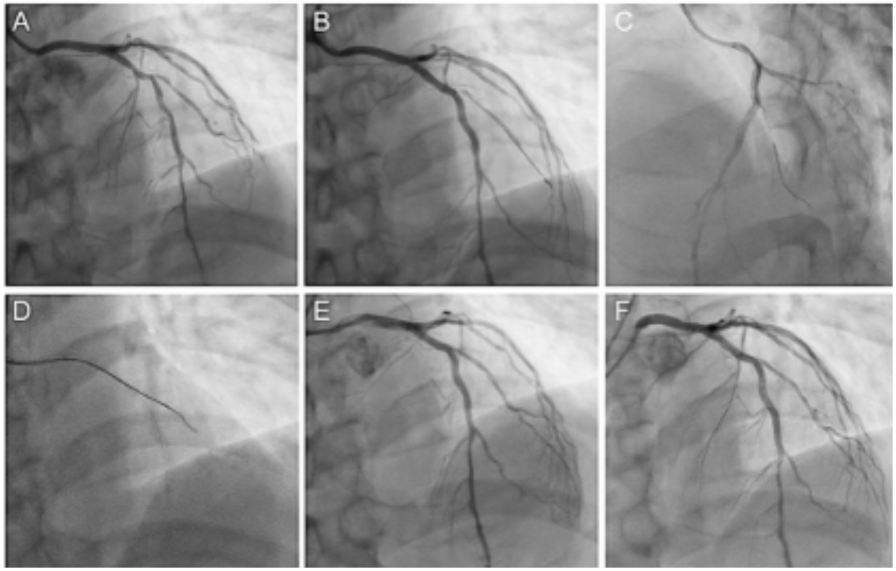 Morita Side-Branch Occlusion Figure 2