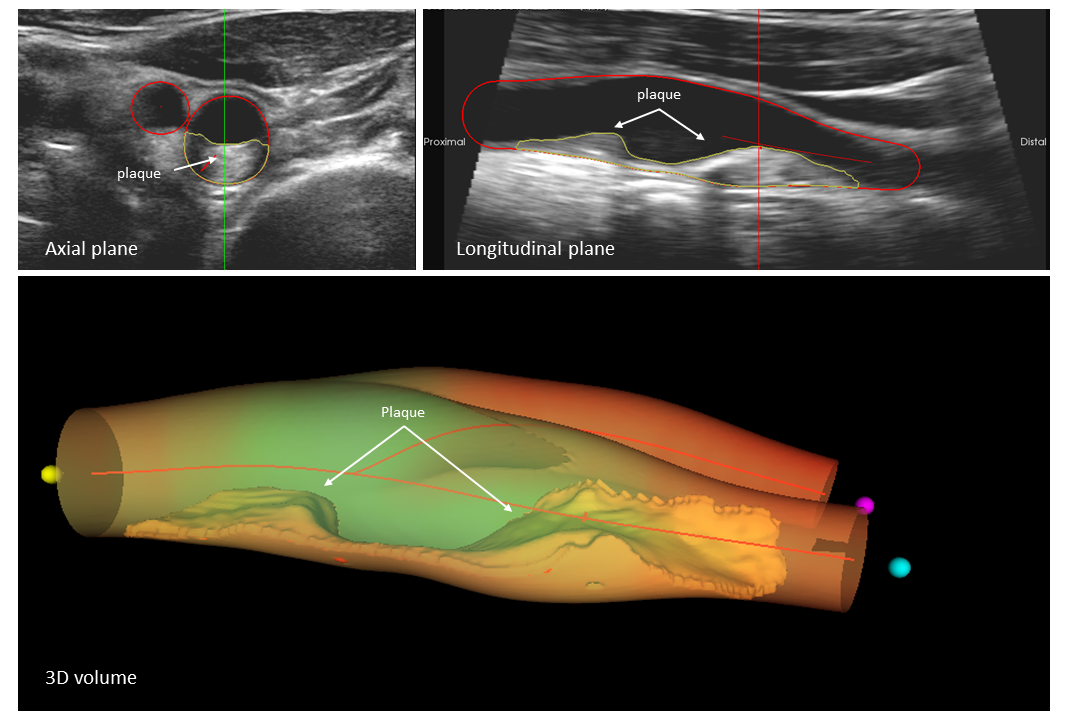 Figure: The images show a large atherosclerotic plaque in a carotid artery. The top panels show an axial view (left) and a longitudinal view (right). The 3D volumetric representation (bottom) provides a detailed and accurate visualization of the plaque, allowing a thorough assessment of the disease.