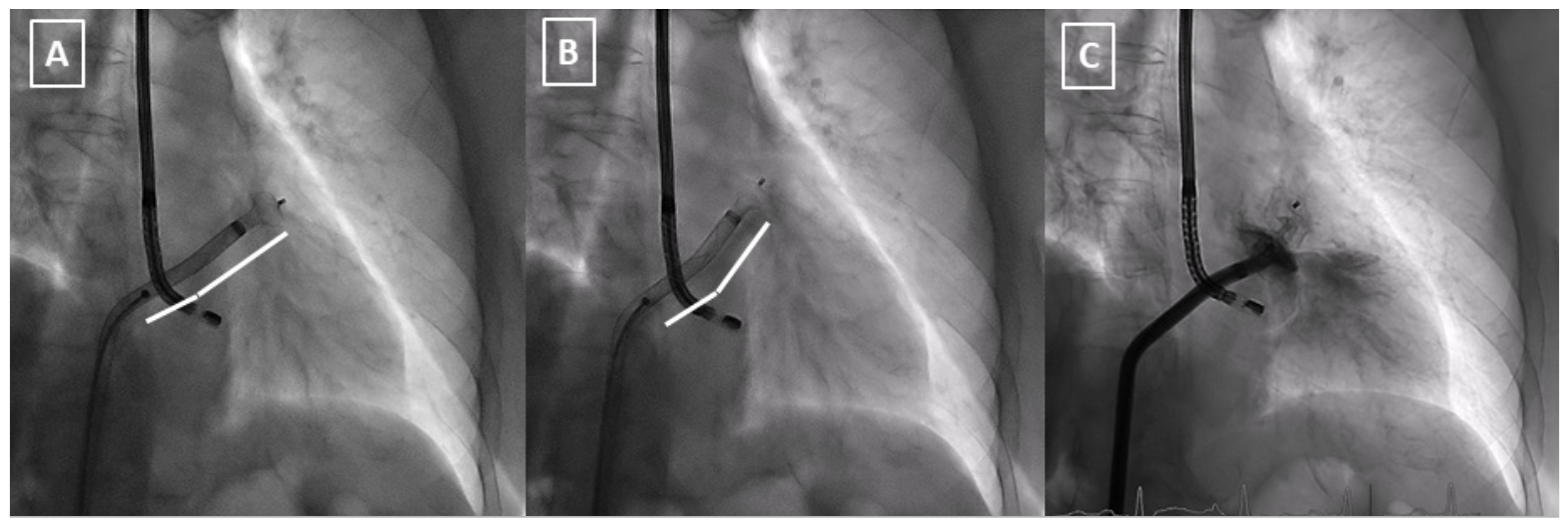 Muiños Amplatzer Figure 3