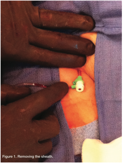 Mumford pull a sheath Figure 1