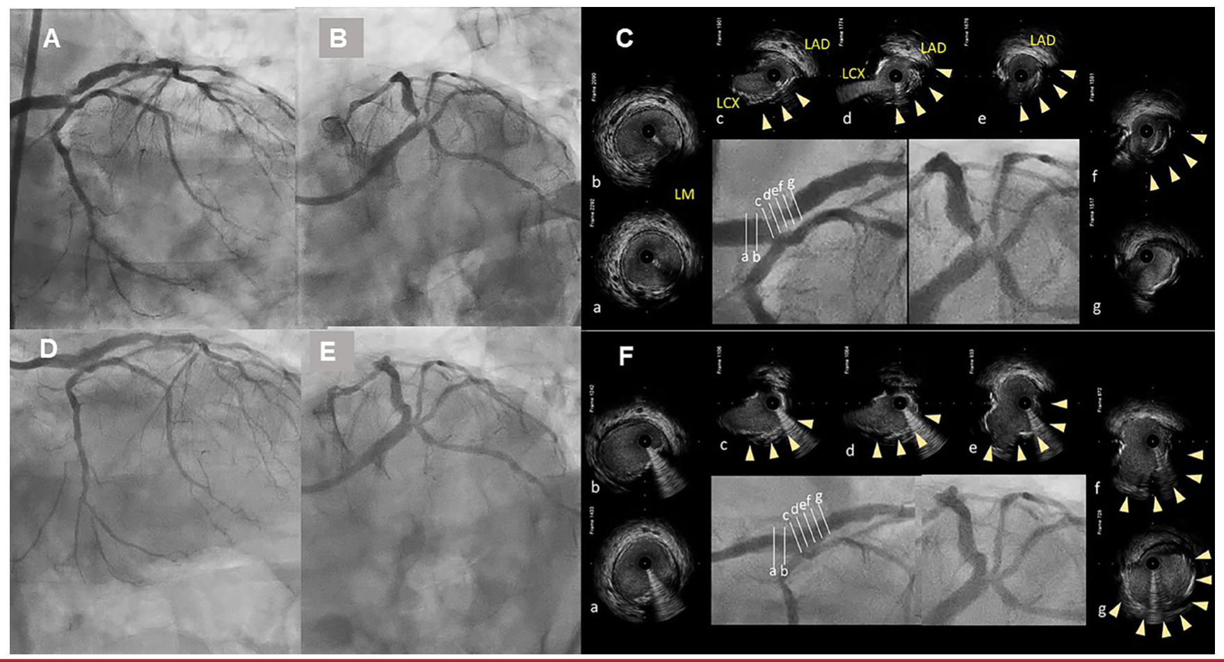 Murasato Quadrifurcation Lesion Figure 1