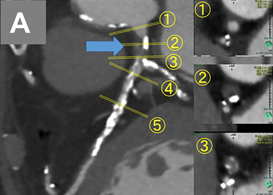 Figure. Case presentation. (A) Coronary computed tomography angiography 