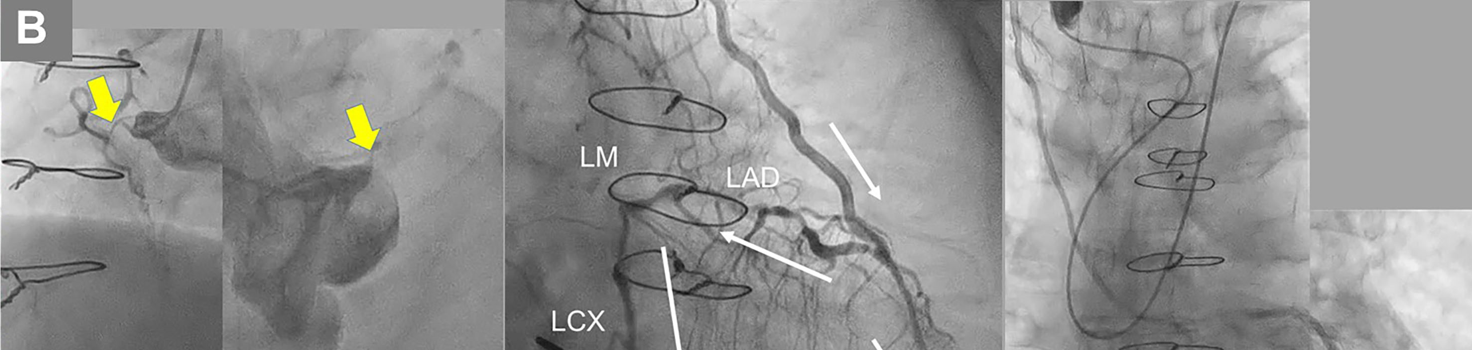Figure. Case presentation. (B) Baseline angiography