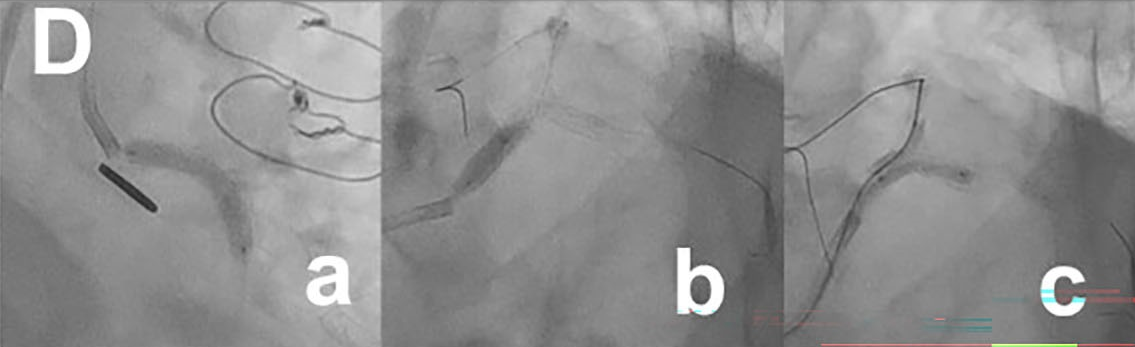 Figure. (D) Coronary intervention: (a) stent deployment from the LM to the LCX artery; (b) proximal optimization technique; (c) final kissing balloon inflation.
