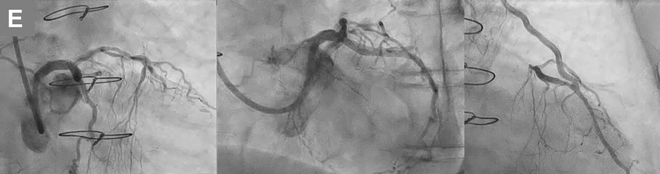 Figure. (E) Final angiography