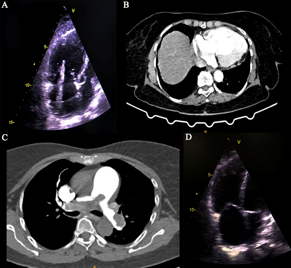 Figure 1. (A) Echocardiography .
